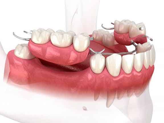 Illustration of partial dentures?