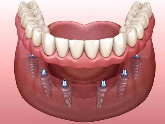 Illustration of implant dentures