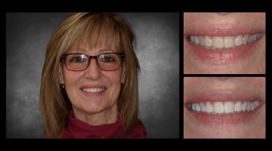 Teeth before and after correcting discoloration