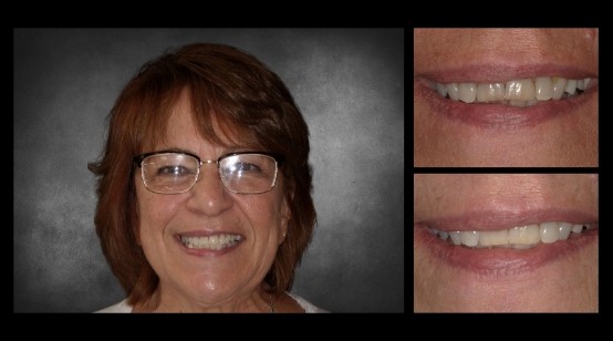 Teeth before and after correcting discoloration