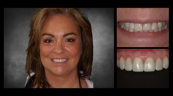 Teeth before and after correcting discoloration