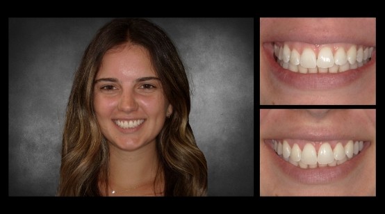 Teeth before and after correcting discoloration