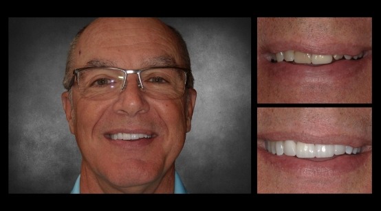 Teeth before and after correcting discoloration