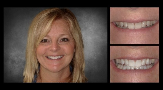 Teeth before and after correcting discoloration