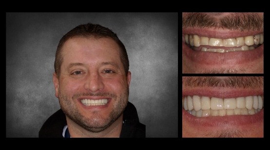 Teeth before and after correcting discoloration