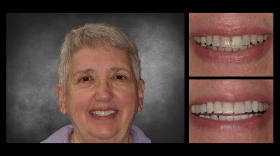 Teeth before and after correcting discoloration