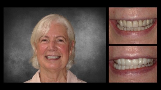 Teeth before and after correcting discoloration